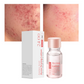 Today Only🎉Buy 1 Get 1 Free💆‍♀️Salicylic Acid Acne-Fighting Essence Toner