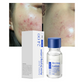 Today Only🎉Buy 1 Get 1 Free💆‍♀️Salicylic Acid Acne-Fighting Essence Toner