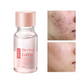 Today Only🎉Buy 1 Get 1 Free💆‍♀️Salicylic Acid Acne-Fighting Essence Toner